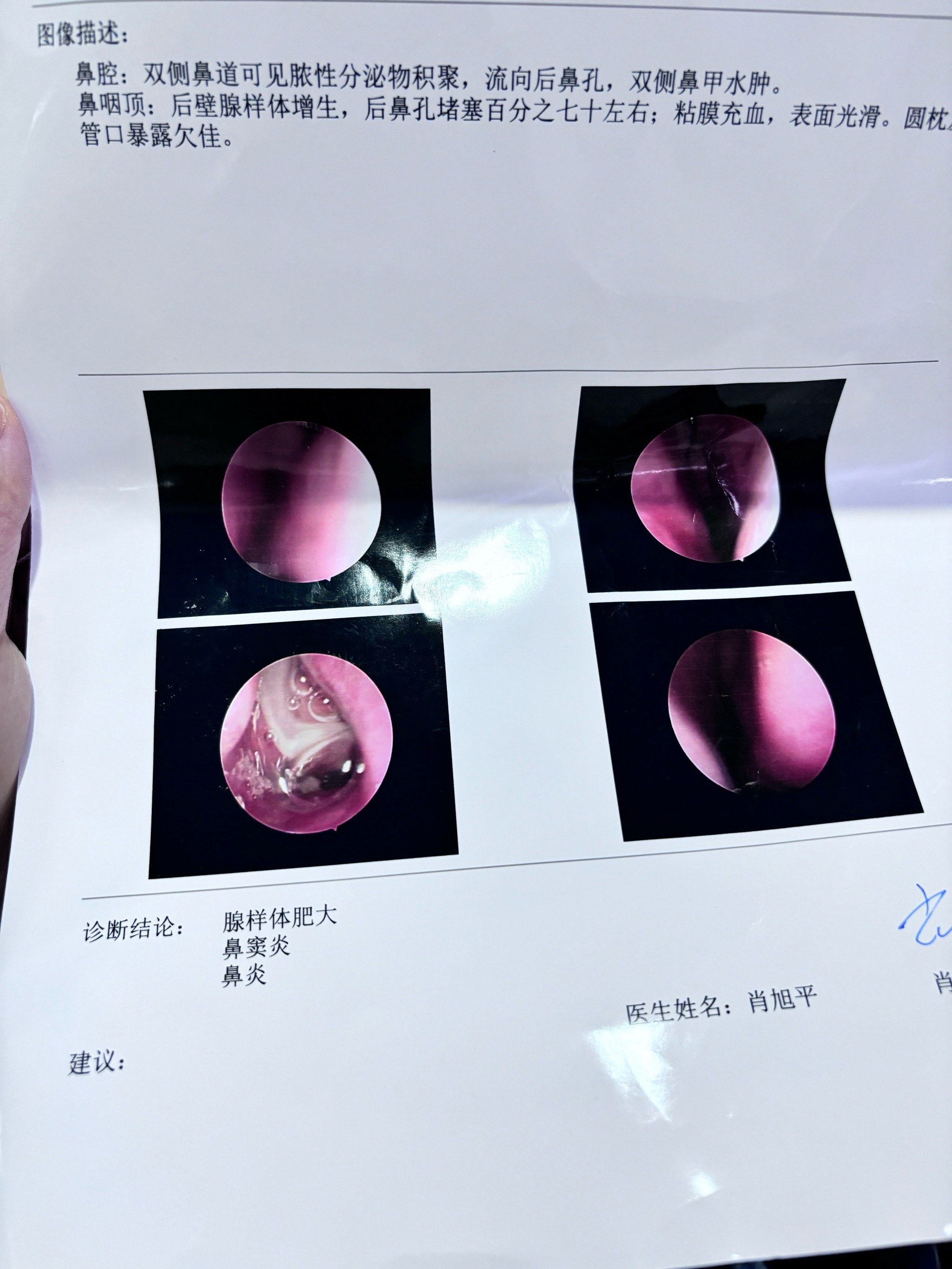 腺样体肥大,到底要不要手术呢?