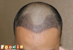 -大麦微针植发丨全国连锁