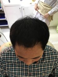 -大麦微针植发全国连锁