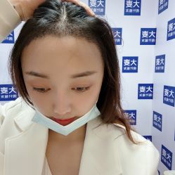 -大麦微针植发丨全国连锁