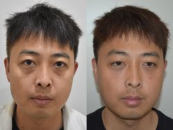 -广州健丽·去眼袋医疗美容机构