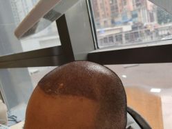 -碧莲盛·不剃发植发