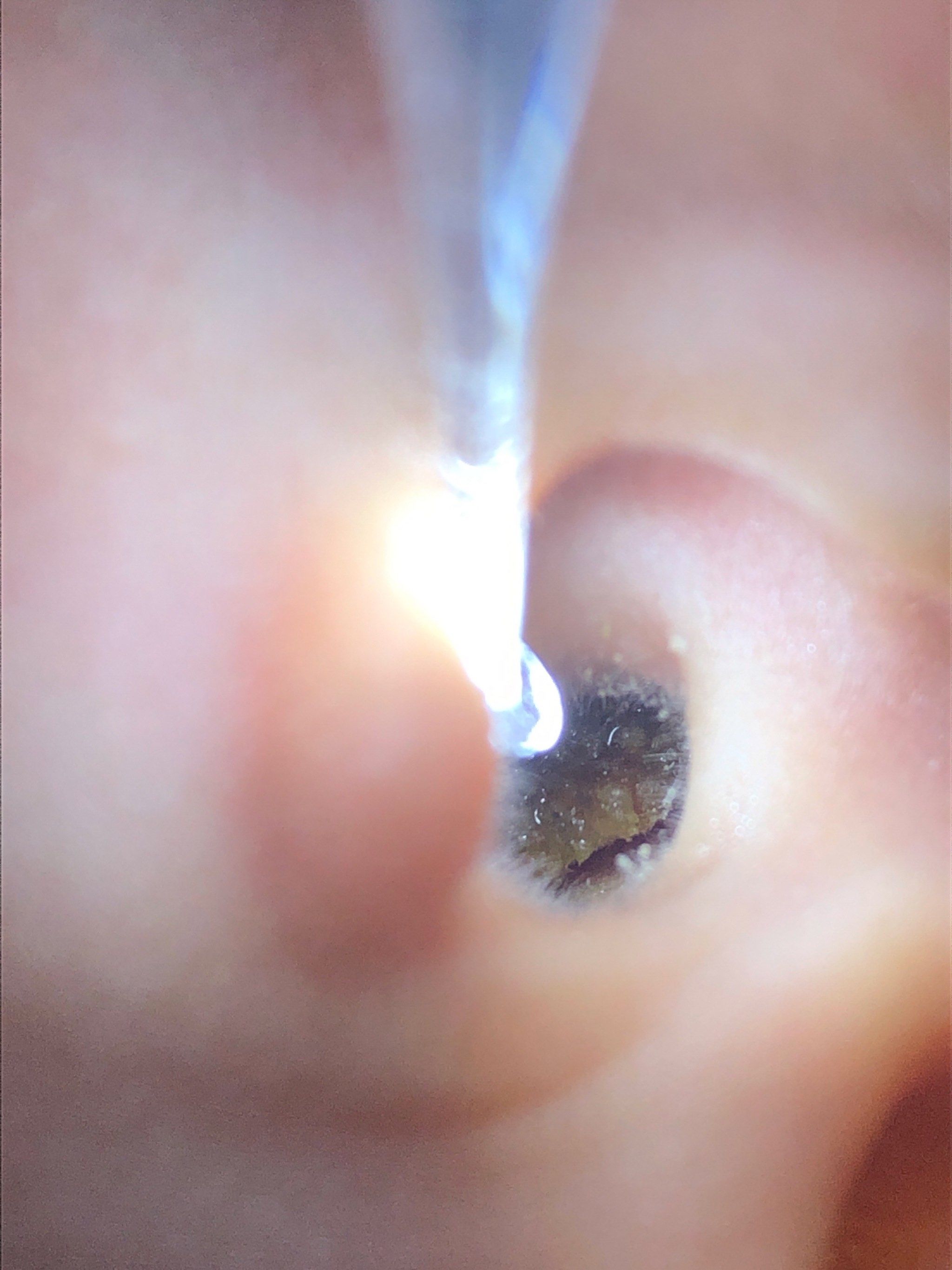 宝宝耳道耵聍_神助攻开塞露