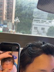 点击看大图 -碧莲盛·不剃发植发