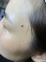 -北京美痣堂古方祛痣斑疣瘊