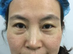 -天津健丽·去眼袋医疗美容机构