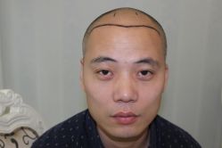 -大麦微针植发丨全国连锁