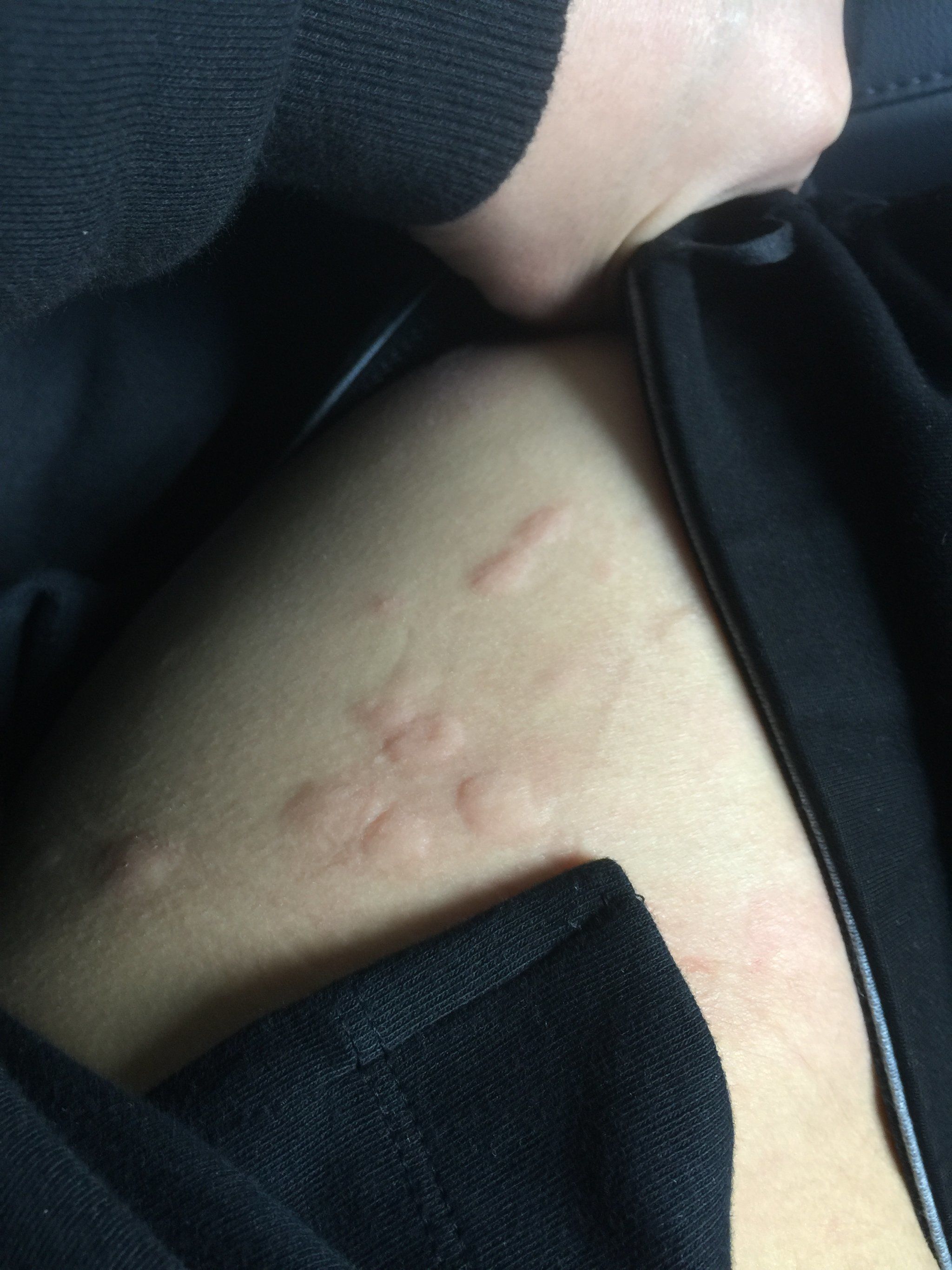 钟小姐也是荨麻疹老客户介绍过来的