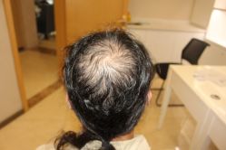 -大麦微针植发丨全国连锁