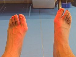 -足太医扦脚·灰指甲·嵌甲