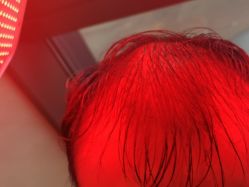 -碧莲盛·不剃发植发