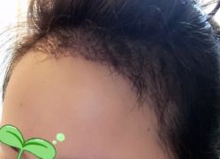 -大麦微针植发丨全国连锁