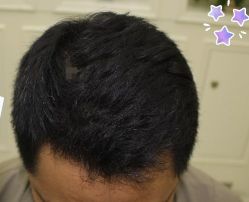 -大麦微针植发丨全国连锁