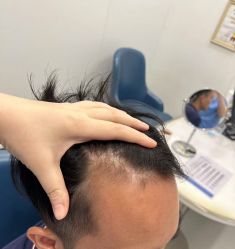 -大麦微针植发全国连锁