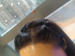 -碧莲盛·不剃发植发