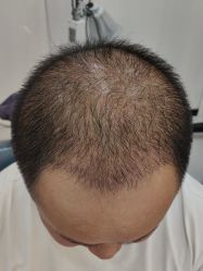 -大麦微针植发全国连锁