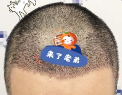 -大麦微针植发全国连锁