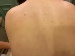 -清疣美疣·痣·斑净肤中心