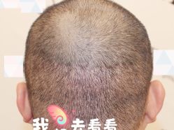 -大麦微针植发全国连锁