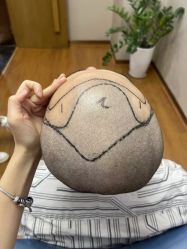 -大麦微针植发全国连锁