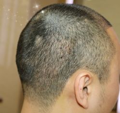 -大麦微针植发丨全国连锁