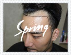 -大麦微针植发全国连锁