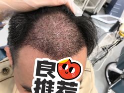-大麦微针植发全国连锁