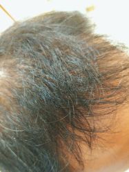 -碧莲盛·不剃发植发