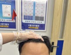 -大麦微针植发全国连锁