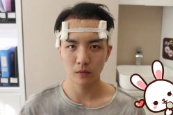 -大麦微针植发丨全国连锁