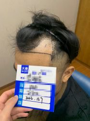 -大麦微针植发全国连锁