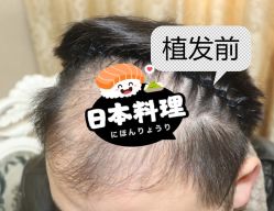 -大麦微针植发全国连锁