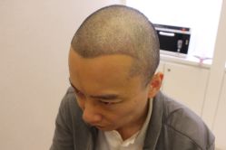 点击看大图 -大麦微针植发丨全国连锁