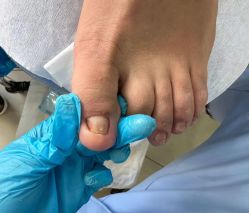 -德哥灰指甲脚气甲沟炎跖疣护理