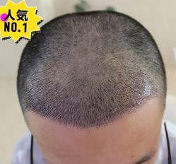 -大麦微针植发丨全国连锁