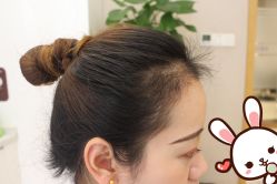 点击看大图 -大麦微针植发丨全国连锁