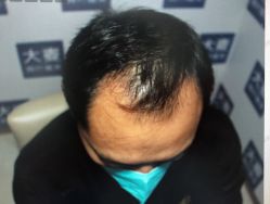 体验前-大麦微针植发丨全国连锁