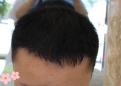 -大麦微针植发丨全国连锁