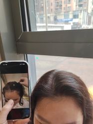 -碧莲盛·不剃发植发