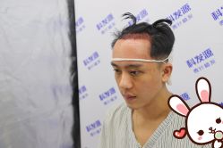 -大麦微针植发丨全国连锁