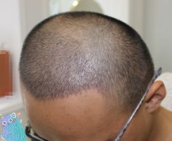 -大麦微针植发丨全国连锁