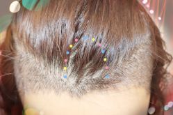 -大麦微针植发全国连锁