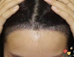 点击看大图 -大麦微针植发全国连锁