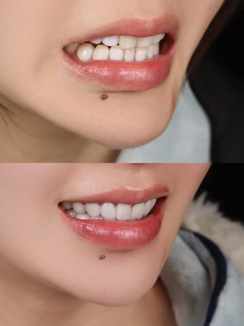 亮白牙齿自然闪耀