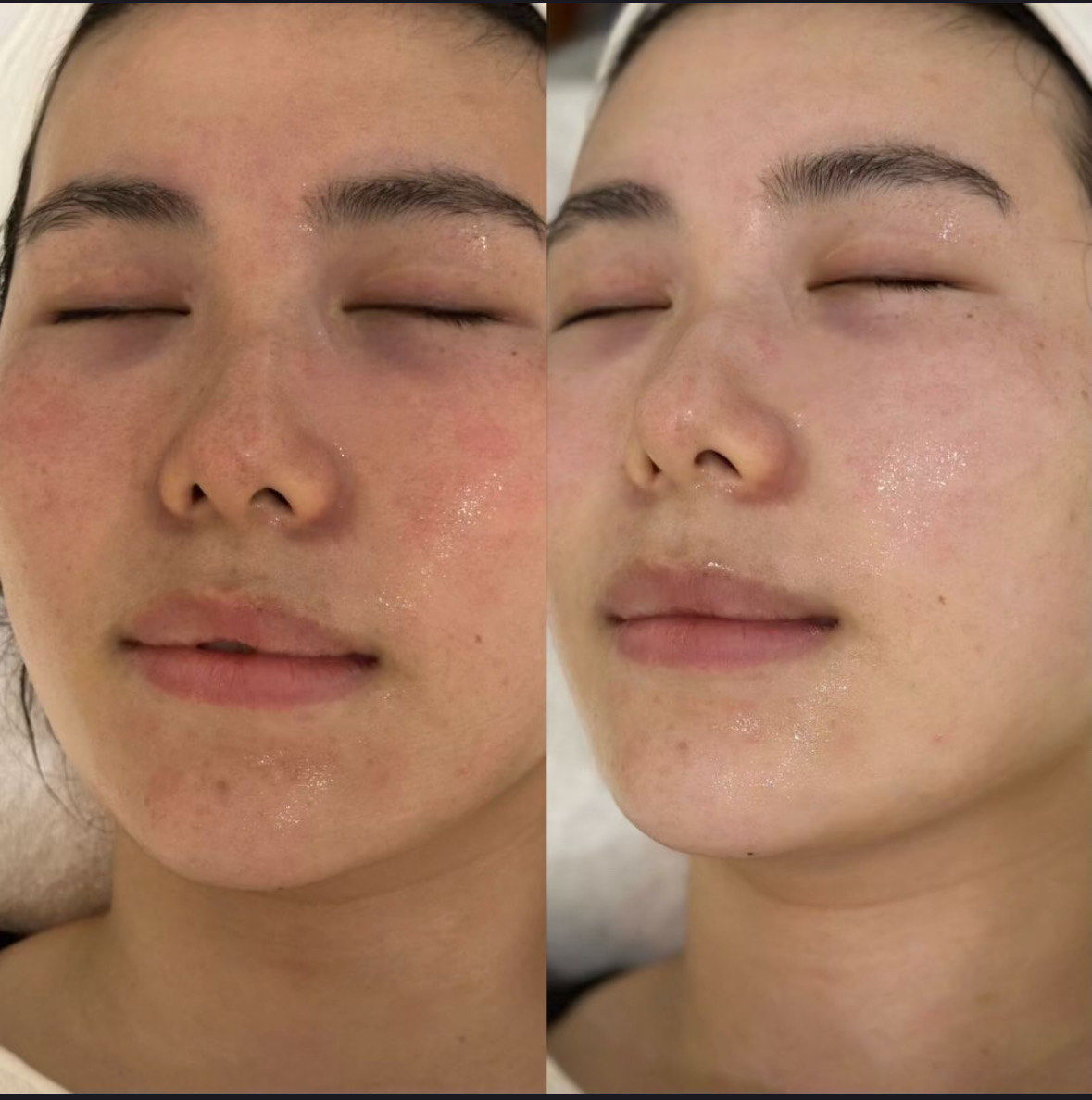 美白水光三次疗程
