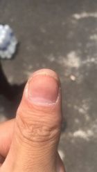 -德哥灰指甲脚气甲沟炎跖疣护理