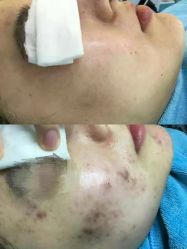 点击看大图 -肤原祛痘·科技修肤中心