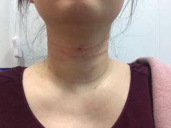 体验后-郡艺医疗美容·微整·眼鼻吸脂