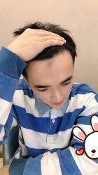 点击看大图 -大麦微针植发丨全国连锁