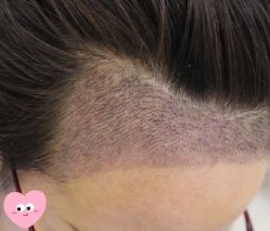 -大麦微针植发丨全国连锁